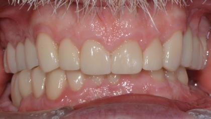 After image of Porcelain Crowns