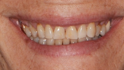 Before image of Porcelain Crowns