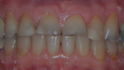 Before image of Full Mouth Crowns