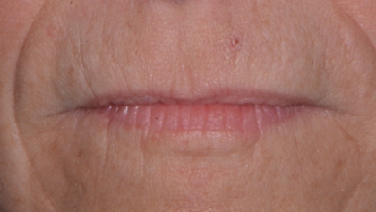 Before image of Lip Dermal Filler