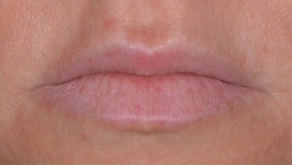 Before image of Lip Dermal Filler