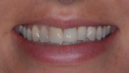 Before image of Replacement Of Old Implant Crown