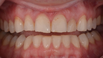 Before image of Combination Of Veneers And Crowns
