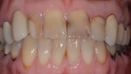 Before image of Porcelain Crowns