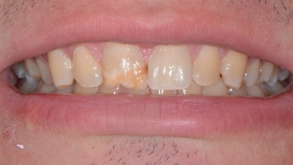 Before image of Single Veneer
