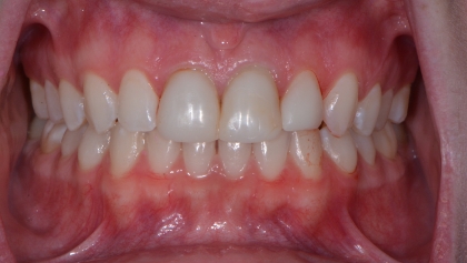 Before image of Porcelain Veneers