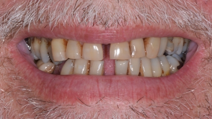 Before image of Full Mouth Crowns