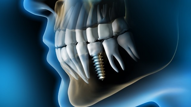 Animated side profile of person with tooth replaced with BioHorizons dental implant