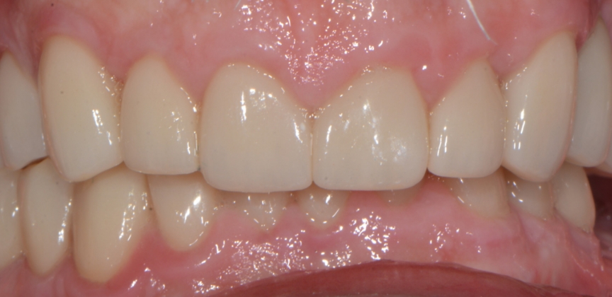 Smile with damaged decayed and missing teeth before dental treatment