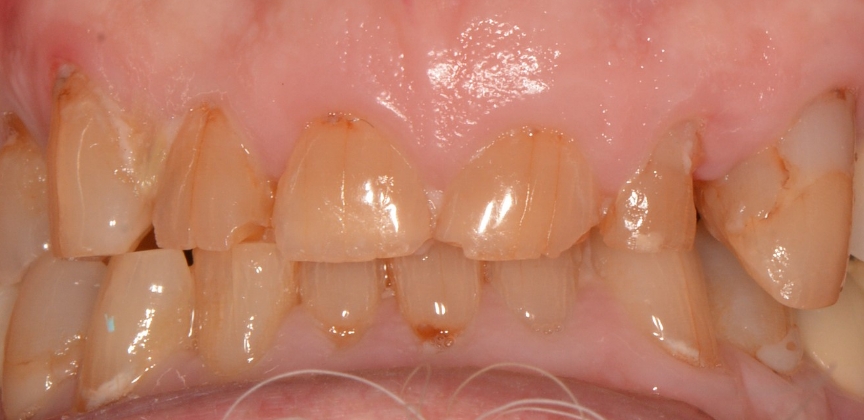 Smile after restorative dental treatment