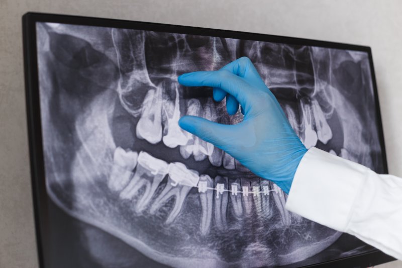 closeup of dental x-ray in Colchester