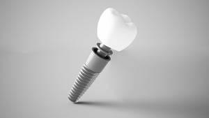 3D render of a dental implant